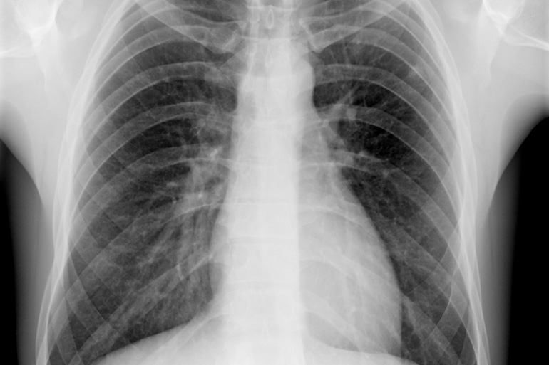 Lung x-ray Lung x-ray