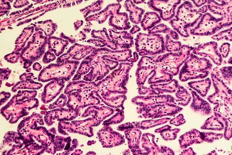 Thyroid cancer cells Thyroid cancer cells