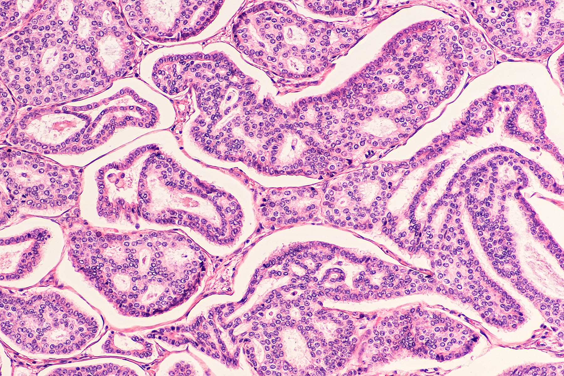 Image: Microscopic view of breast cancer cells Image: Microscopic view of breast cancer cells