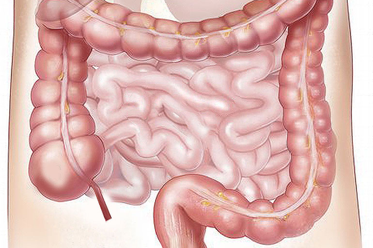 Interdisciplinary approach uncovers new clues to triggers of gut inflammation Interdisciplinary approach uncovers new clues to triggers of gut inflammation