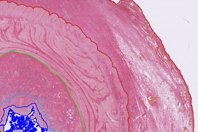 Annotations of intestinal wall layers and histology images of normal and crohn's disease affected ileum samples. Credit: Prof Mark Arends